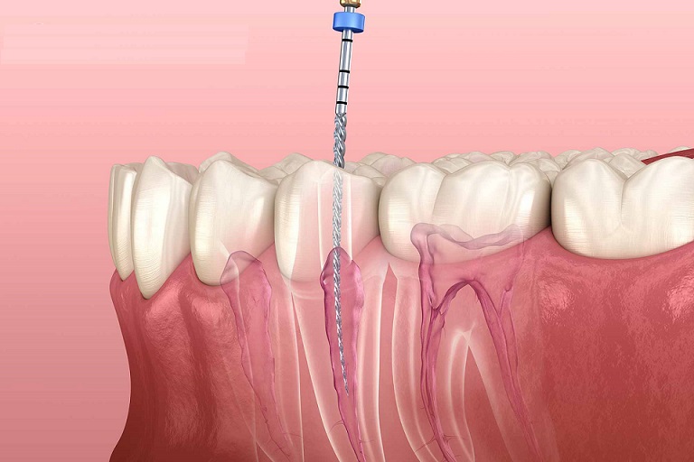 ROOT CANAL TREATMENT (RCT)
